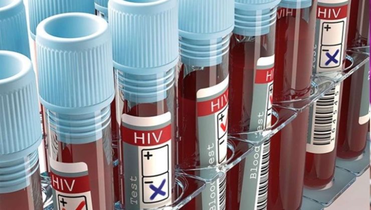 HIV virüsü nedir, belirtileri nelerdir? HIV Enfeksiyonu (AIDS) nasıl bulaşır?